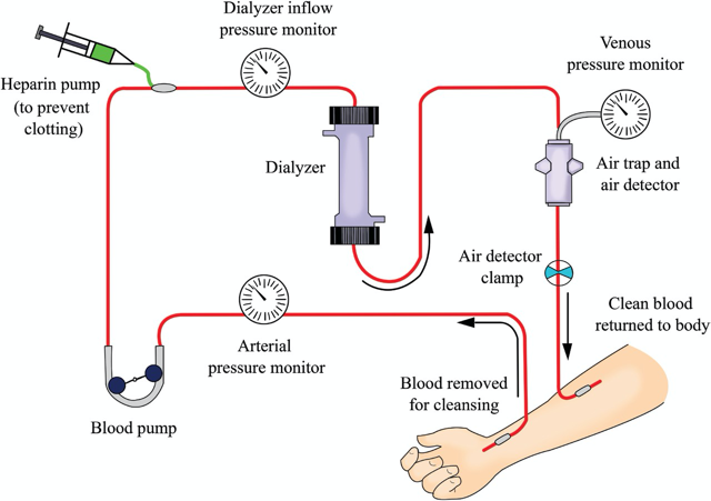 blood-circuit-for-hemodialysis-by-dr-jigar-shrimali-glom-india